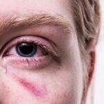 「痣(あざ)」痛い思いをした証:英語では何ていうのでしょう。